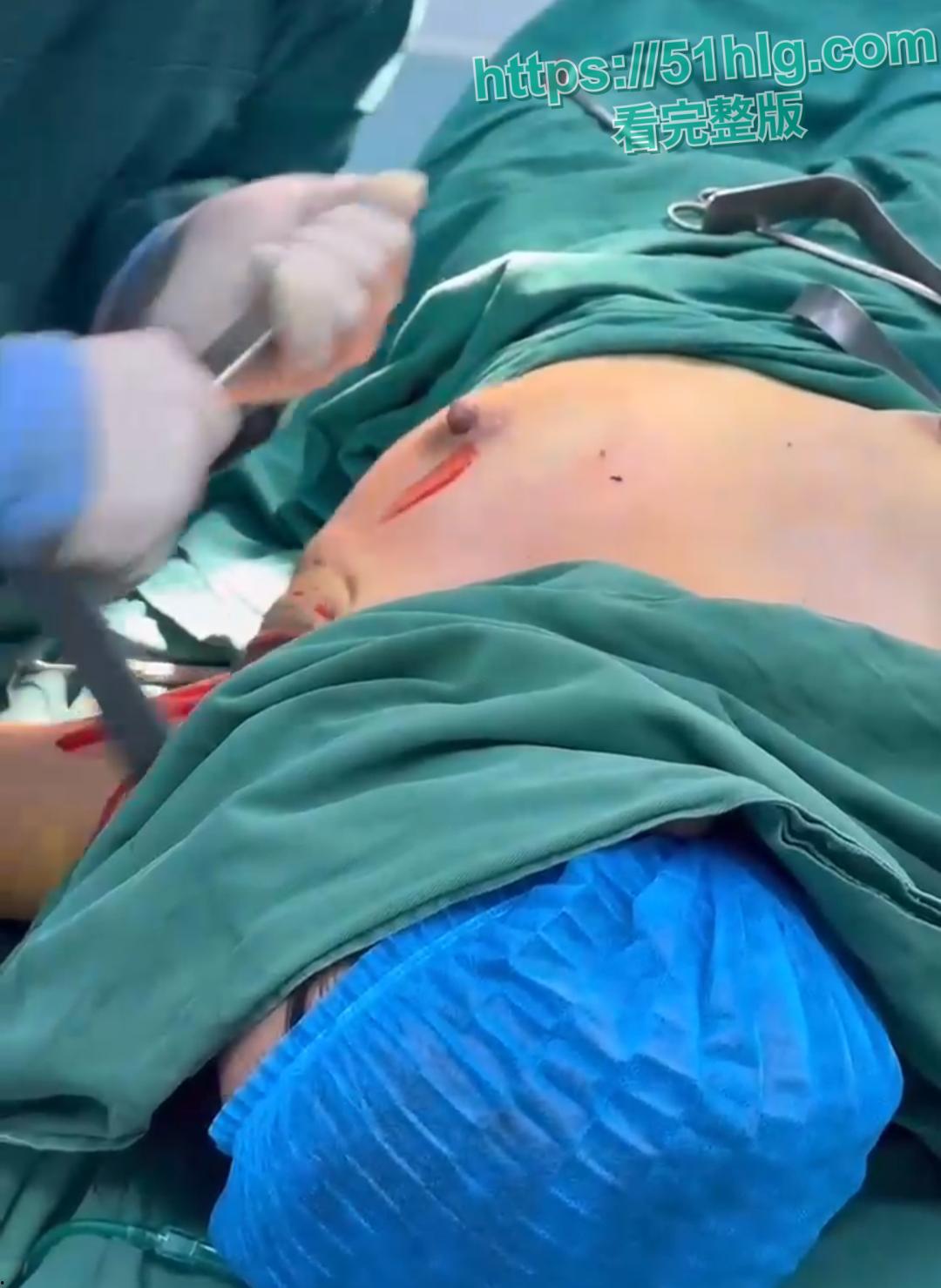 隆胸整形手术现场震惊你的眼球!平乳妹秒变巨乳御姐,女人为变美, 对自己真的太狠了-2