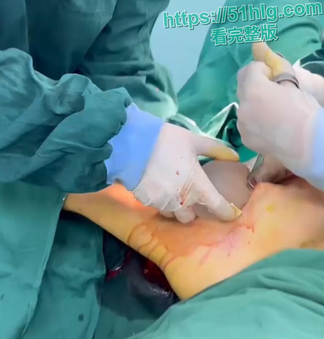 隆胸整形手术现场震惊你的眼球!平乳妹秒变巨乳御姐,女人为变美, 对自己真的太狠了-3