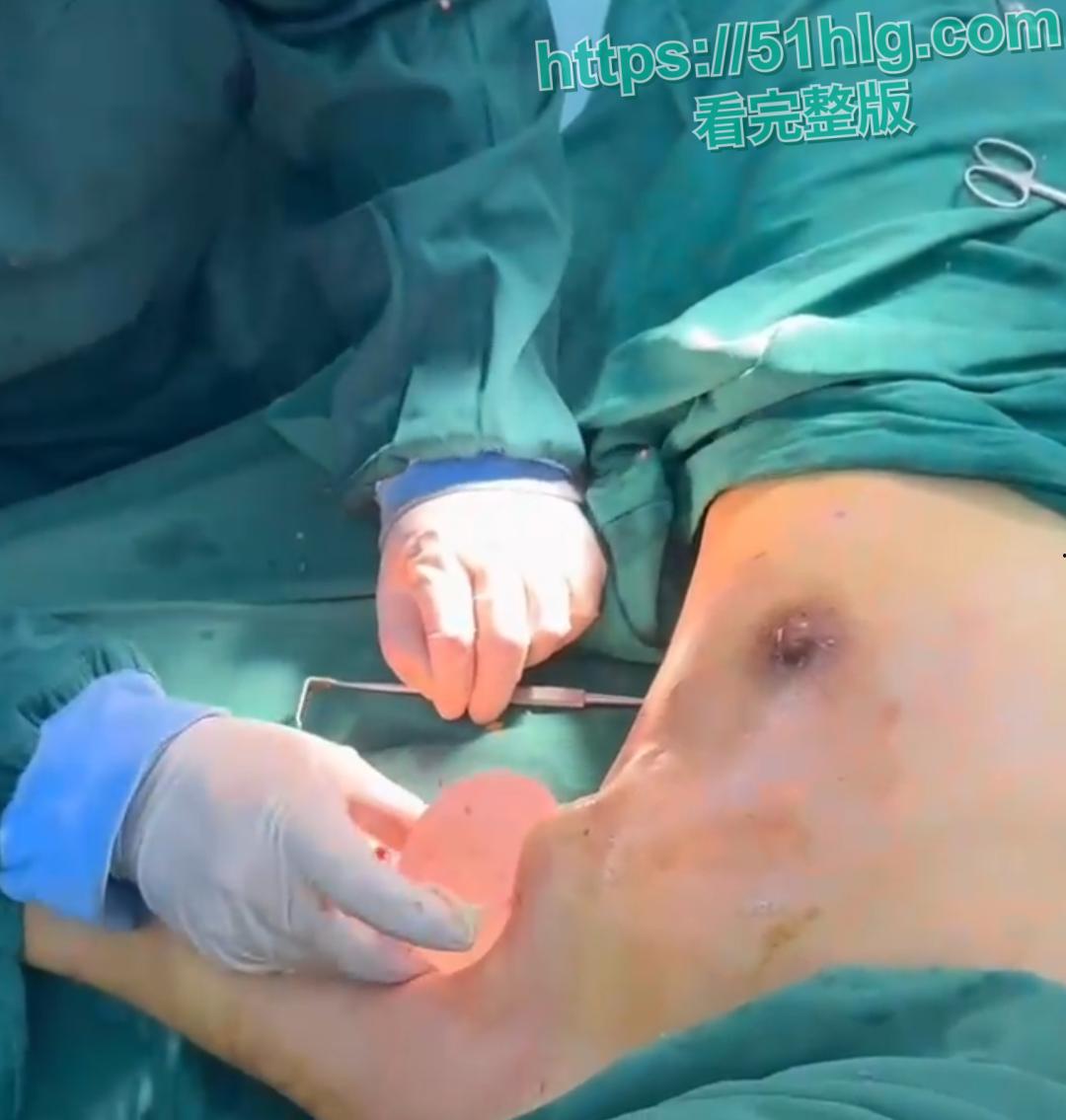 隆胸整形手术现场震惊你的眼球!平乳妹秒变巨乳御姐,女人为变美, 对自己真的太狠了-5