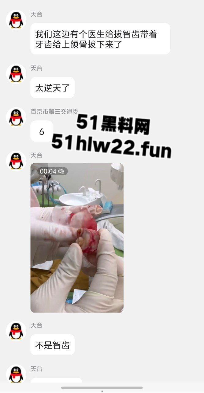 口腔医院逆天操作,客人拔智齿结果医生不分青红皂白直接大力出奇迹, 把上颌骨拔断撤了下来!-4