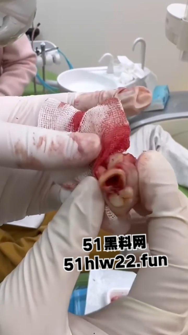 口腔医院逆天操作,客人拔智齿结果医生不分青红皂白直接大力出奇迹, 把上颌骨拔断撤了下来!-5