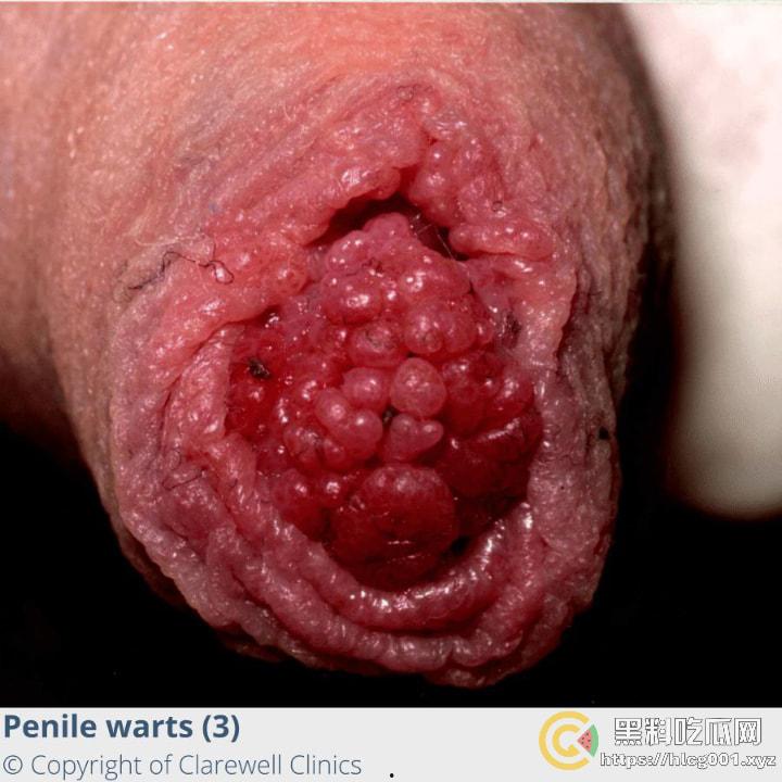 性病篇  谨慎观看！瓜友们出门在外 一定得洁身自爱 世界上没有后悔药  安全第一！！！ （二）-11