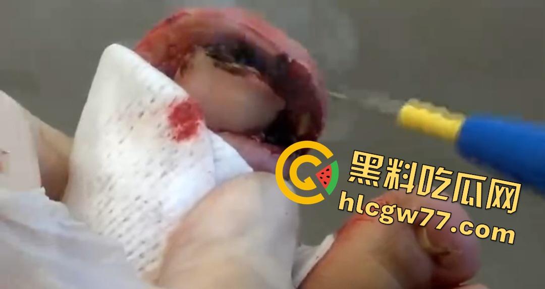患者天天啃脚指甲狂得甲沟炎！帕尔米耶里手术刀下血肉狂飙，操刀医生差点呕吐！-3