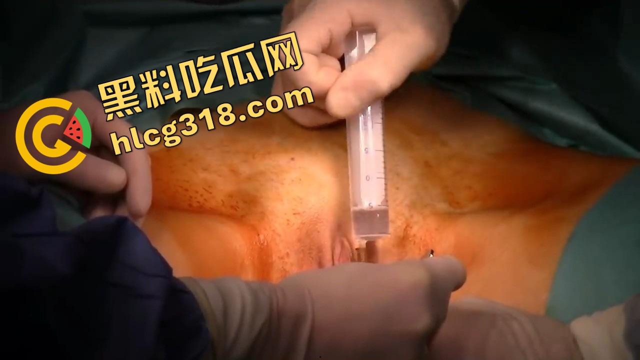 阴唇整形一刀逆天改命，黑木耳变粉鲍鱼，大阴唇手术直接打造一线天馒头逼，姑娘做完直接彩礼翻倍！-8