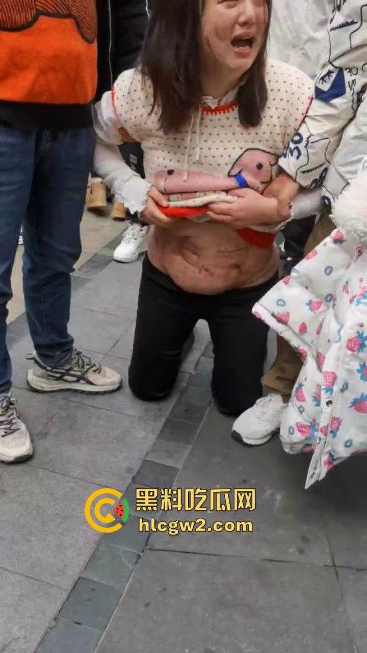 四川泸州胖妹抽脂被戳破大肠差点没命 路边哭喊陈清美容院血债血偿-5