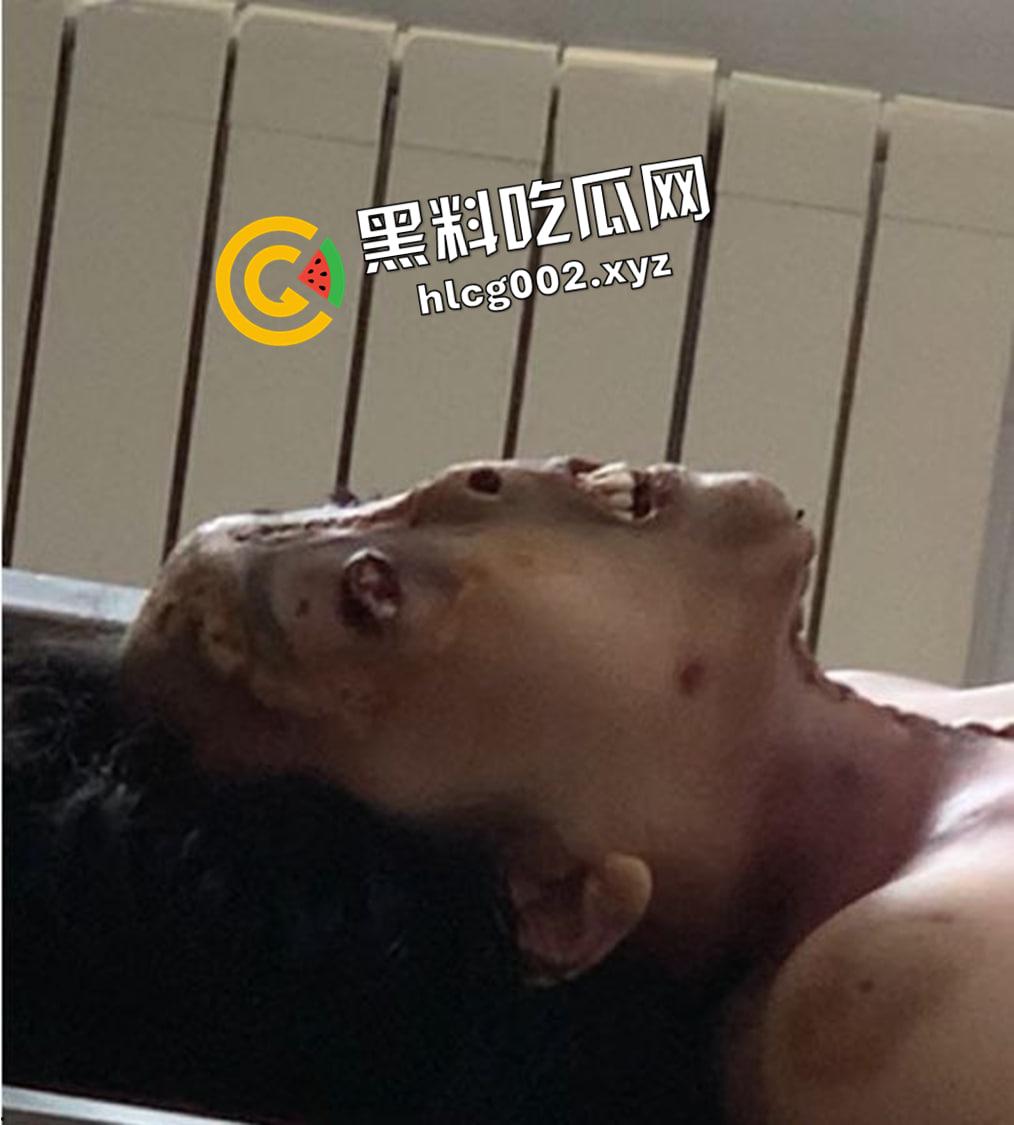 恐怖慎入!辽宁【徐园】案尸检现场视频流出 被前男友家暴致死打的面目全非-5