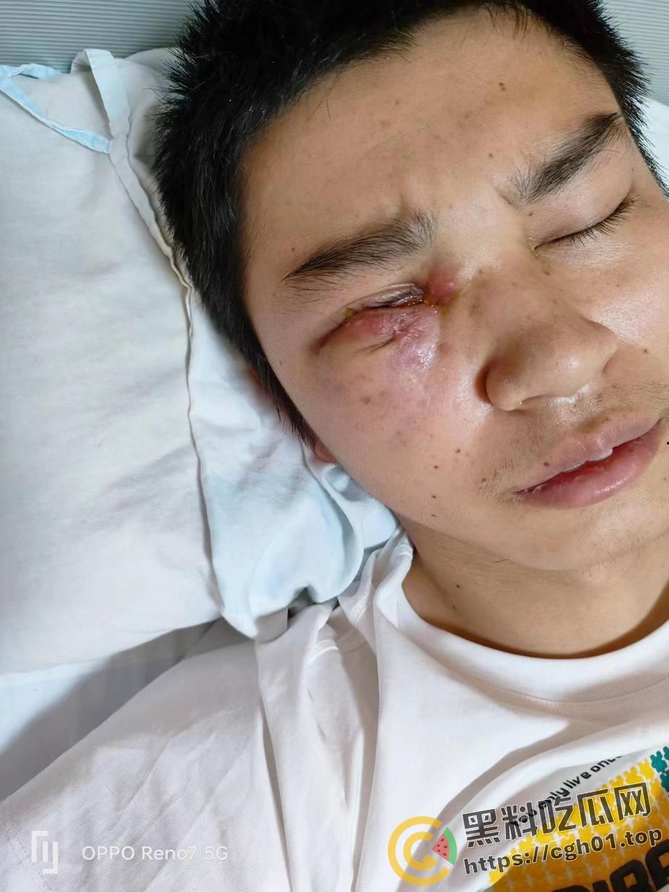 蚌埠大学生为参军做飞秒手术 在部队内遭感染被丢回家 最终不治身亡 家人抖音喊冤被封-10