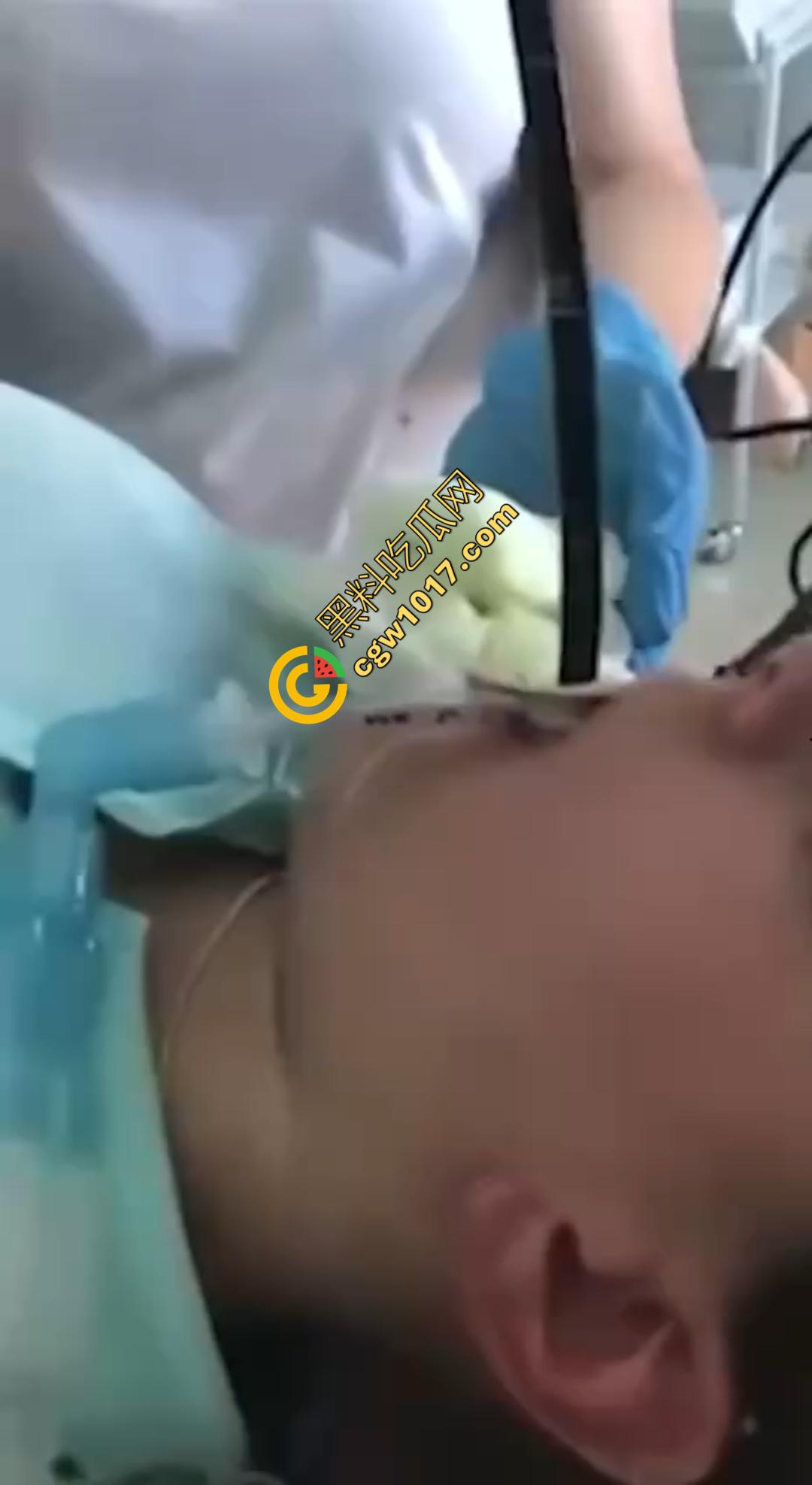 俄罗斯医院活拽1米毒蛇！女患者吞蛇卵孵化钻喉，医生手抖拽出瞬间到处乱窜！-1