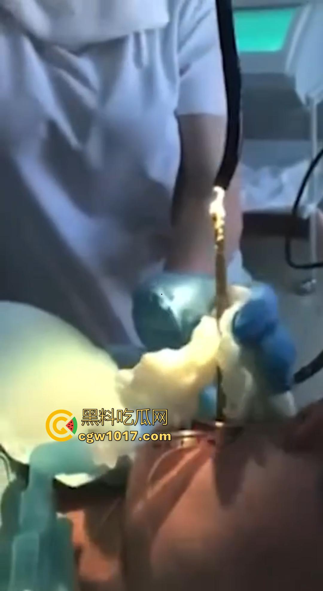 俄罗斯医院活拽1米毒蛇！女患者吞蛇卵孵化钻喉，医生手抖拽出瞬间到处乱窜！-2