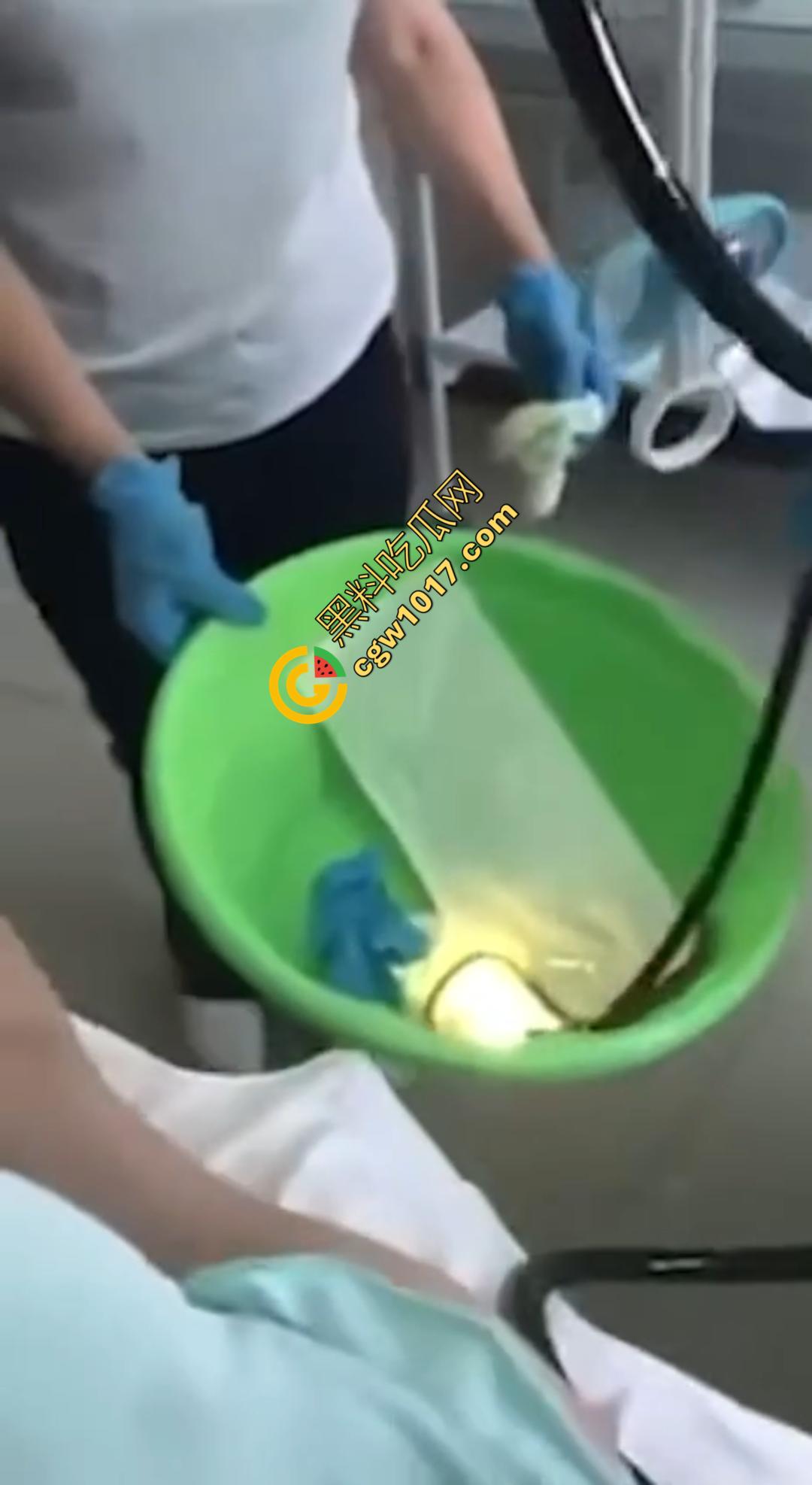 俄罗斯医院活拽1米毒蛇！女患者吞蛇卵孵化钻喉，医生手抖拽出瞬间到处乱窜！-6