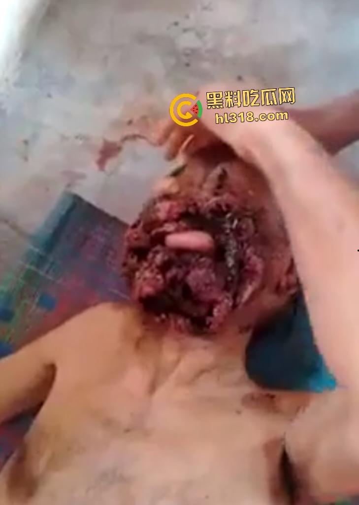 埃及老人惨遭机器重击，脸烂成浆五官全毁，只能阿巴阿巴发声音，不能说话，估计过几天就要长蛆了！-1