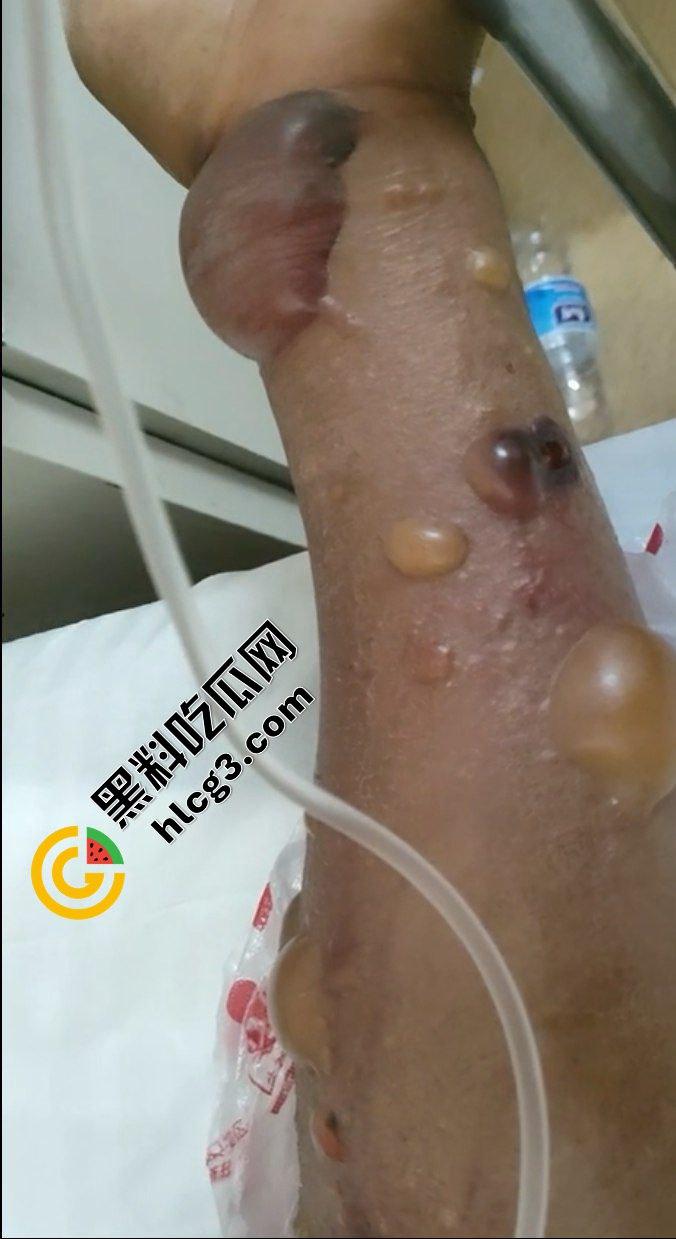 山东聊城阳谷县 一养殖场惊现炭疽病 牛传染人 致当地数十人感染病例-12