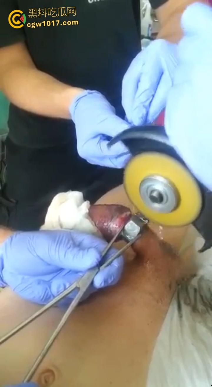 小说照进现实，男子追求刺激螺母自慰，勃起后被螺母卡住，消防人员和医生同时出动，解救被困阴茎 ！-6